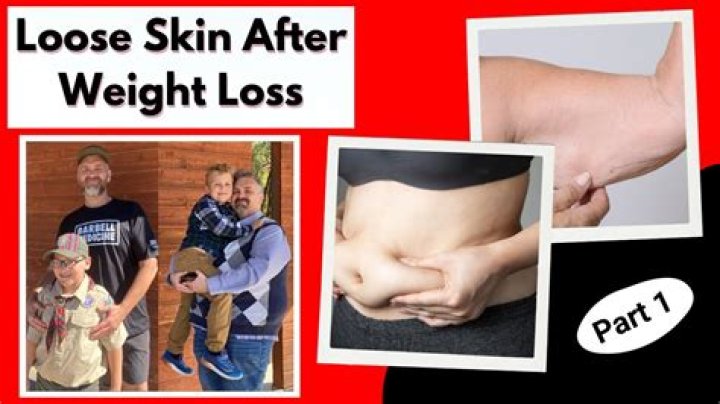 Will I have loose skin after losing 80 pounds?